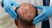 Transplante capilar