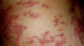Dermatitis por Larva Migrans Cutánea