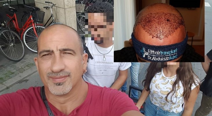 Andrés, turista capilar malagueño que viajó a Turquía para implantarse pelo