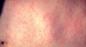 Sarpullido característico del sarampión en la piel|Foto: Centers for Disease Control and Prevention